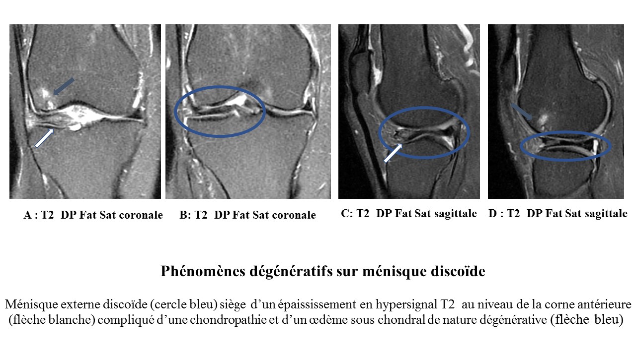 Irm Des L Sions M Connues Du Genou Approche Diagnostique En E Learning