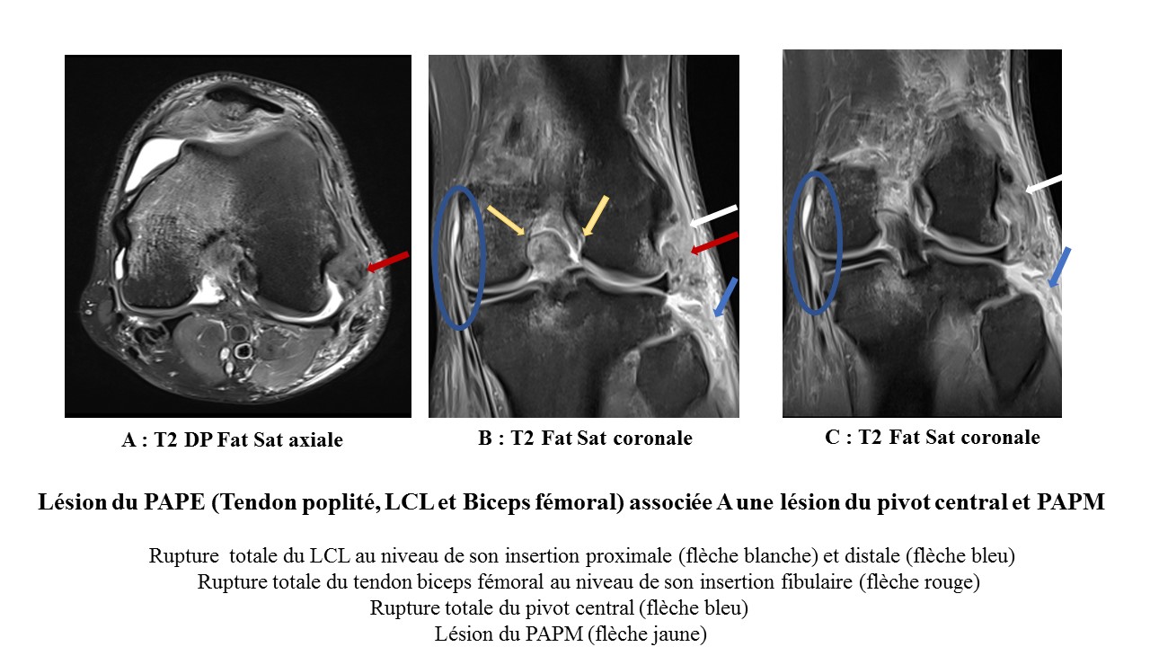 IRM des lésions méconnues du genou Approche diagnostique en e learning